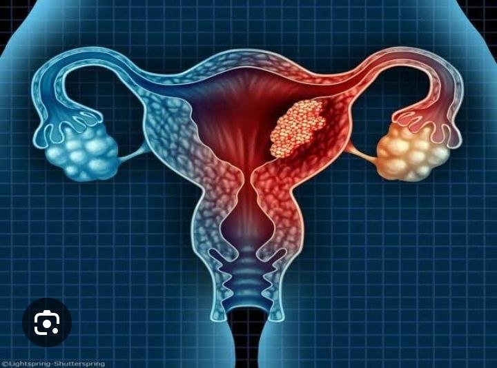 Post Menopause Syndrome